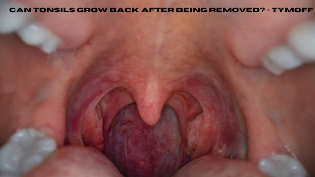 can tonsils grow back after being removed? - tymoff