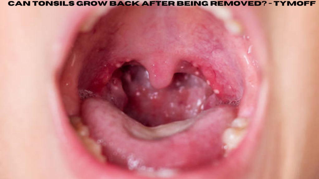 can tonsils grow back after being removed? - tymoff